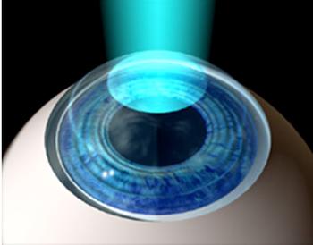 lasik_surgery